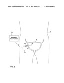 TRANSMEMBRANE SENSING DEVICE FOR SENSING BLADDER CONDITION diagram and image