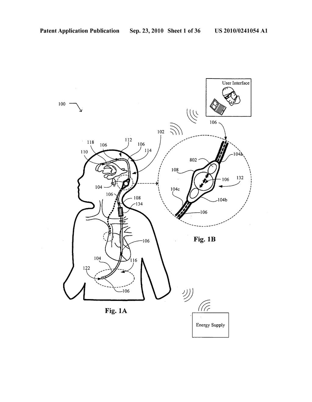 Systems, devices, and methods including infection-fighting and monitoring shunts - diagram, schematic, and image 02