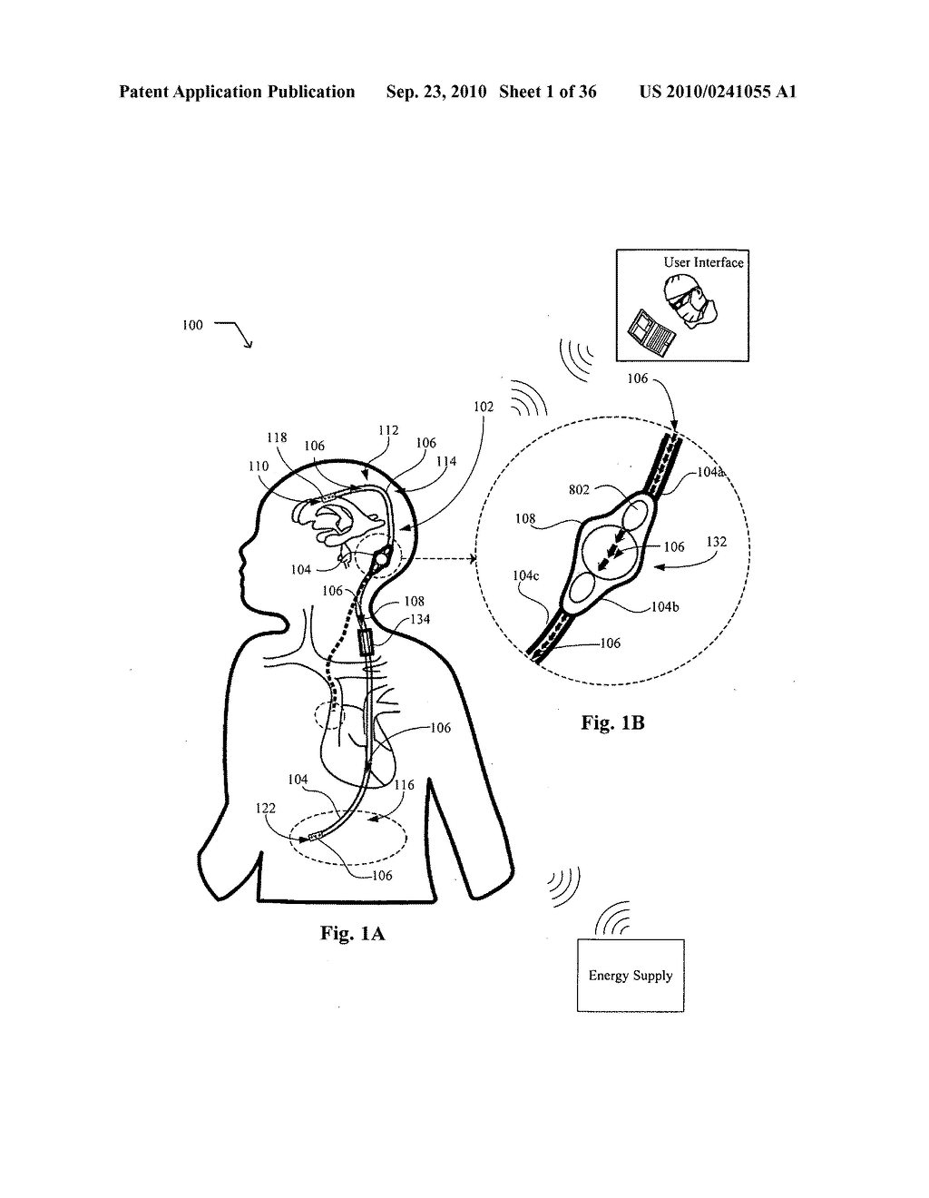 Systems, devices, and methods including infection-fighting and monitoring shunts - diagram, schematic, and image 02