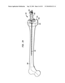 FLEXIBLE INTRAMEDULLARY ROD diagram and image