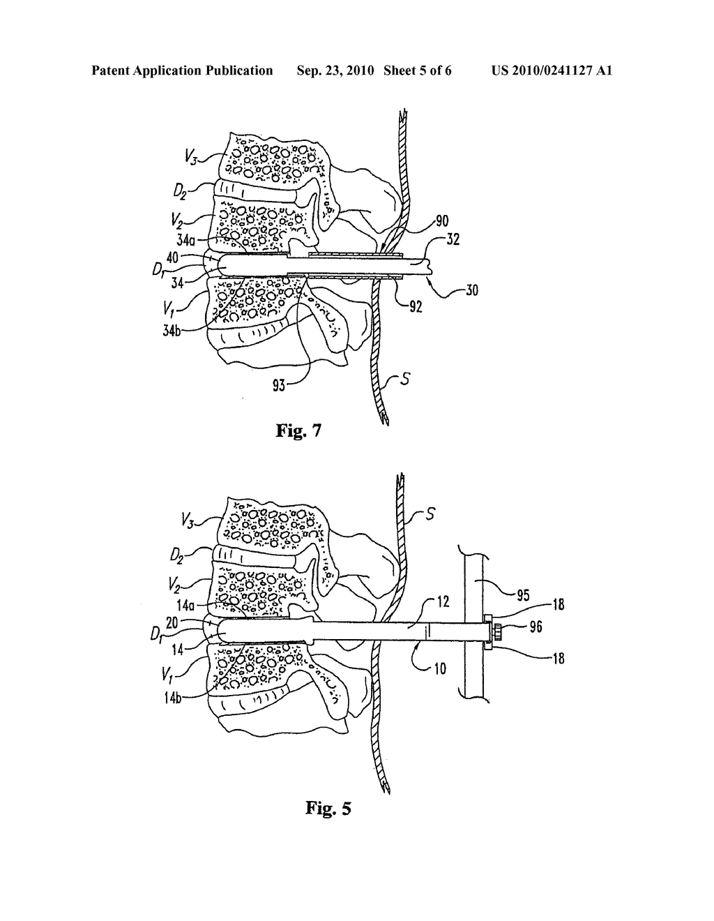 Methods and instrumentation for distraction of a disc space - diagram, schematic, and image 06