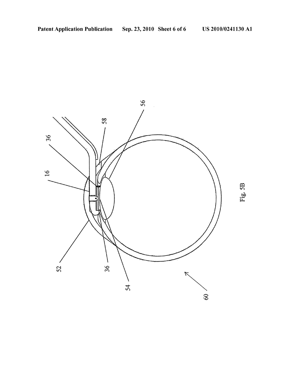 APPARATUS AND METHOD FOR MAKING A CIRCULAR INCISION - diagram, schematic, and image 07