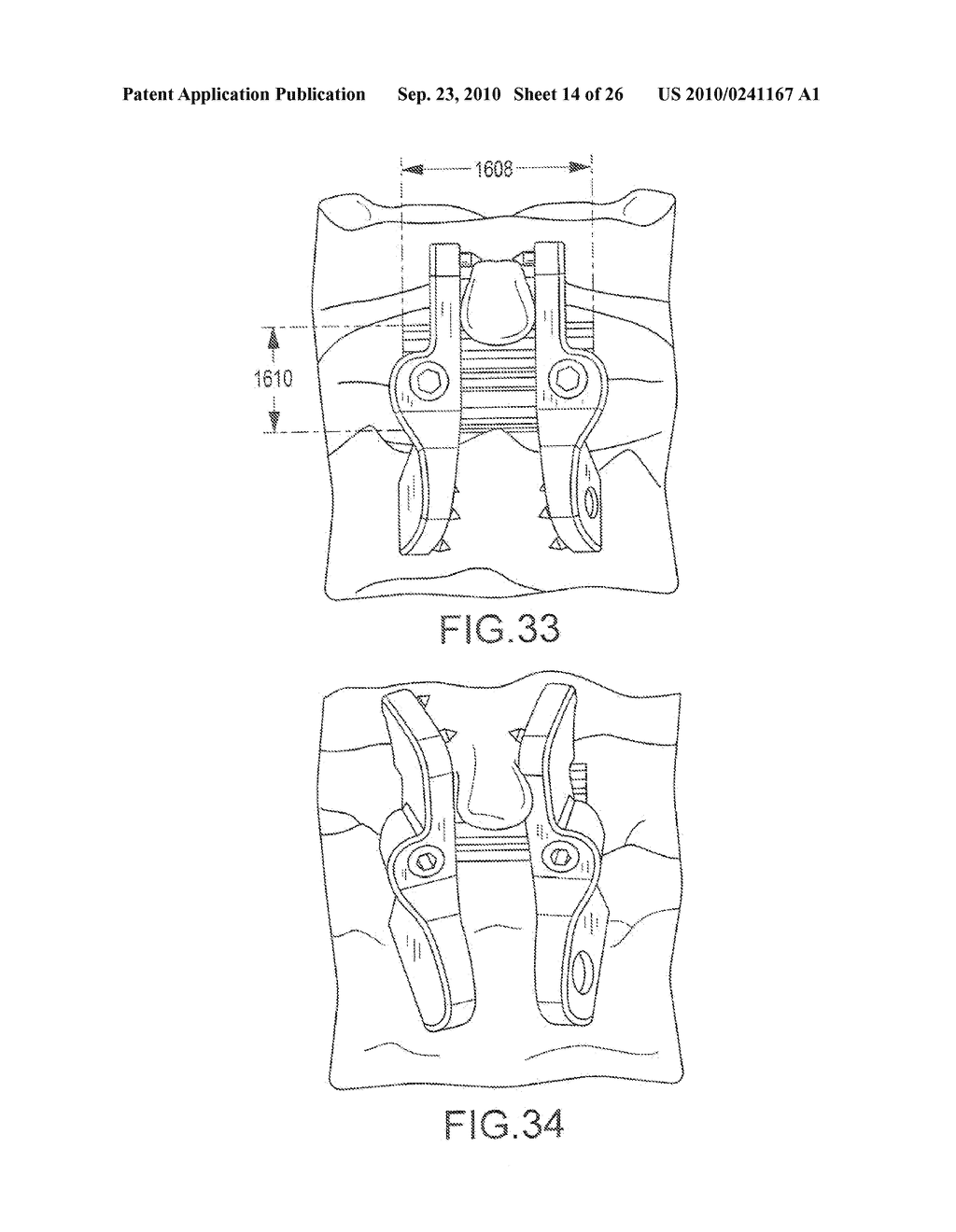 SPINOUS PROCESS IMPLANTS AND ASSOCIATED METHODS - diagram, schematic, and image 15