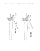 Anatomical Distal Radius Fracture Fixation Plate With Ulnar Buttress diagram and image