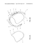 STEERABLE EPICARDIAL PACING CATHETER SYSTEM PLACED VIA THE SUBXIPHOID PROCESS diagram and image