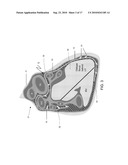 STEERABLE EPICARDIAL PACING CATHETER SYSTEM PLACED VIA THE SUBXIPHOID PROCESS diagram and image