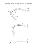 STEERABLE EPICARDIAL PACING CATHETER SYSTEM PLACED VIA THE SUBXIPHOID PROCESS diagram and image