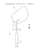 Percutaneous Electrical Treatment Of Tissue diagram and image