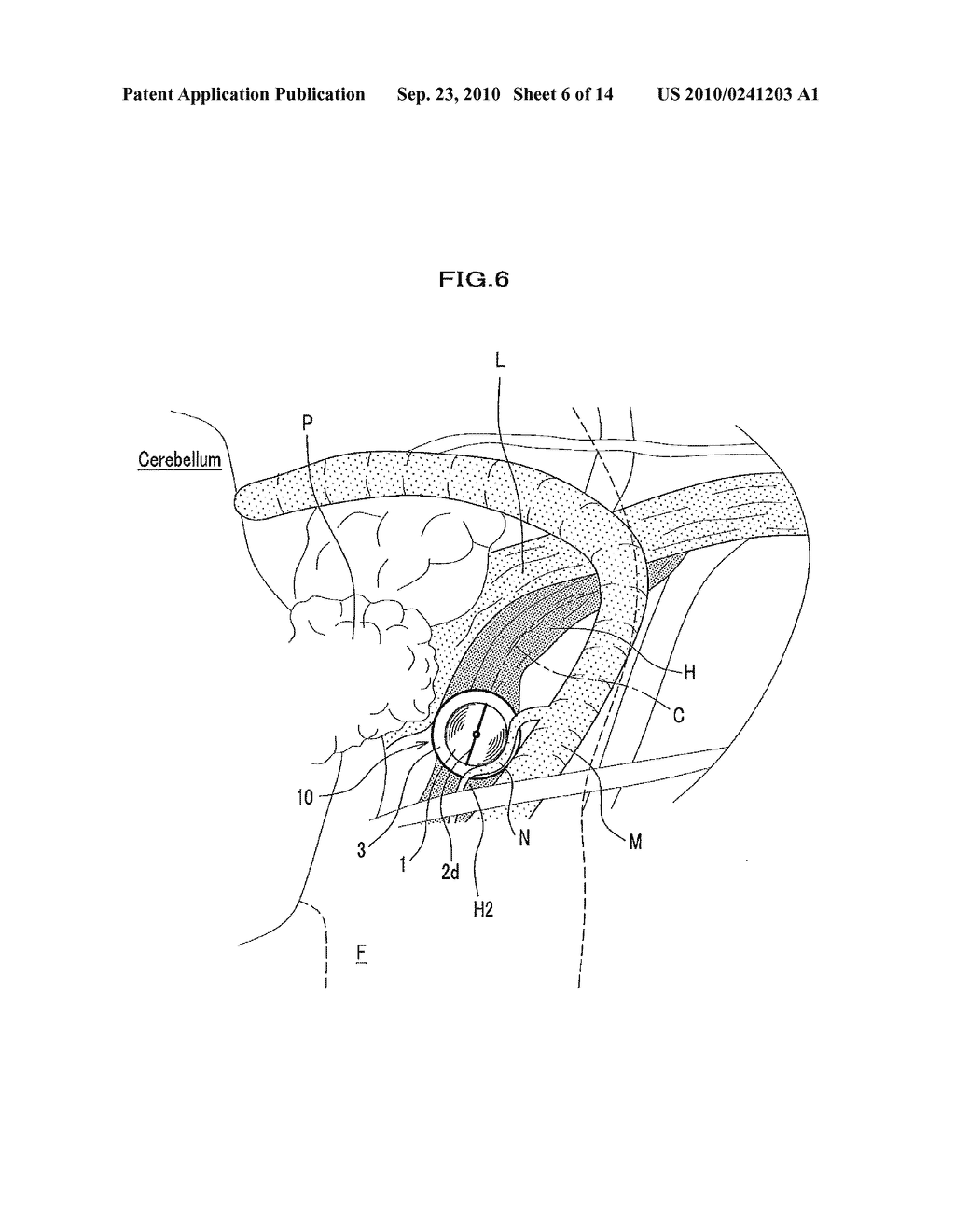 ELECTRODE FOR CONTINUOUSLY STIMULATING FACIAL NERVE ROOT AND APPARATUS FOR MONITORING ELECTROMYOGRAMS OF FACIAL MUSCLES USING THE ELECTRODE THEREOF - diagram, schematic, and image 07