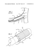 SYSTEM AND METHOD FOR DEPLOYING A PROXIMALLY-FLARING STENT diagram and image