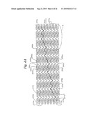 Stent diagram and image