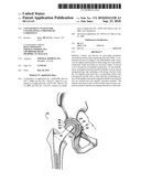 CONTAINMENT SYSTEM FOR CONSTRAINING A PROSTHETIC COMPONENT diagram and image