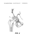 CONTAINMENT SYSTEM FOR CONSTRAINING A PROSTHETIC COMPONENT diagram and image