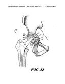 CONTAINMENT SYSTEM FOR CONSTRAINING A PROSTHETIC COMPONENT diagram and image