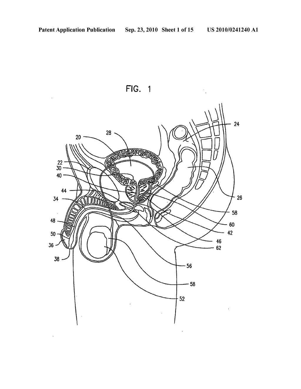 SELF-ADJUSTING ENDOURETHRAL DEVICE & METHODS OF USE - diagram, schematic, and image 02