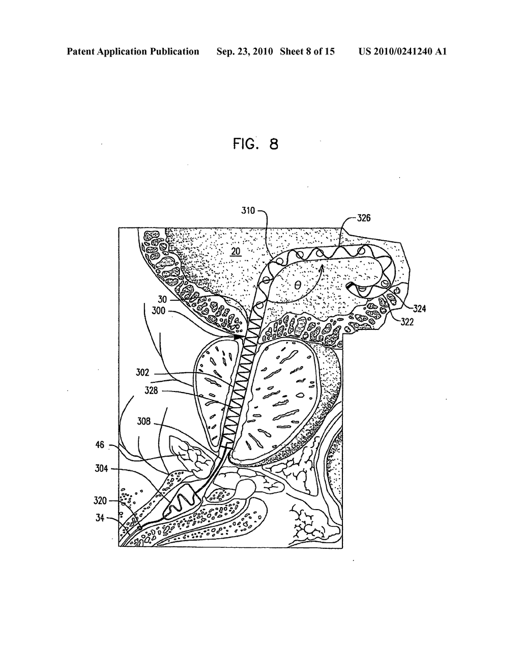 SELF-ADJUSTING ENDOURETHRAL DEVICE & METHODS OF USE - diagram, schematic, and image 09