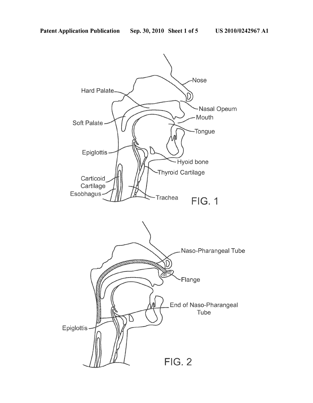 SLEEP APNEA THERAPY WITH NASO-PHYRANGEAL BYPASS - diagram, schematic, and image 02