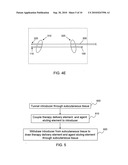 ELEMENT FOR IMPLANTATION WITH MEDICAL DEVICE diagram and image