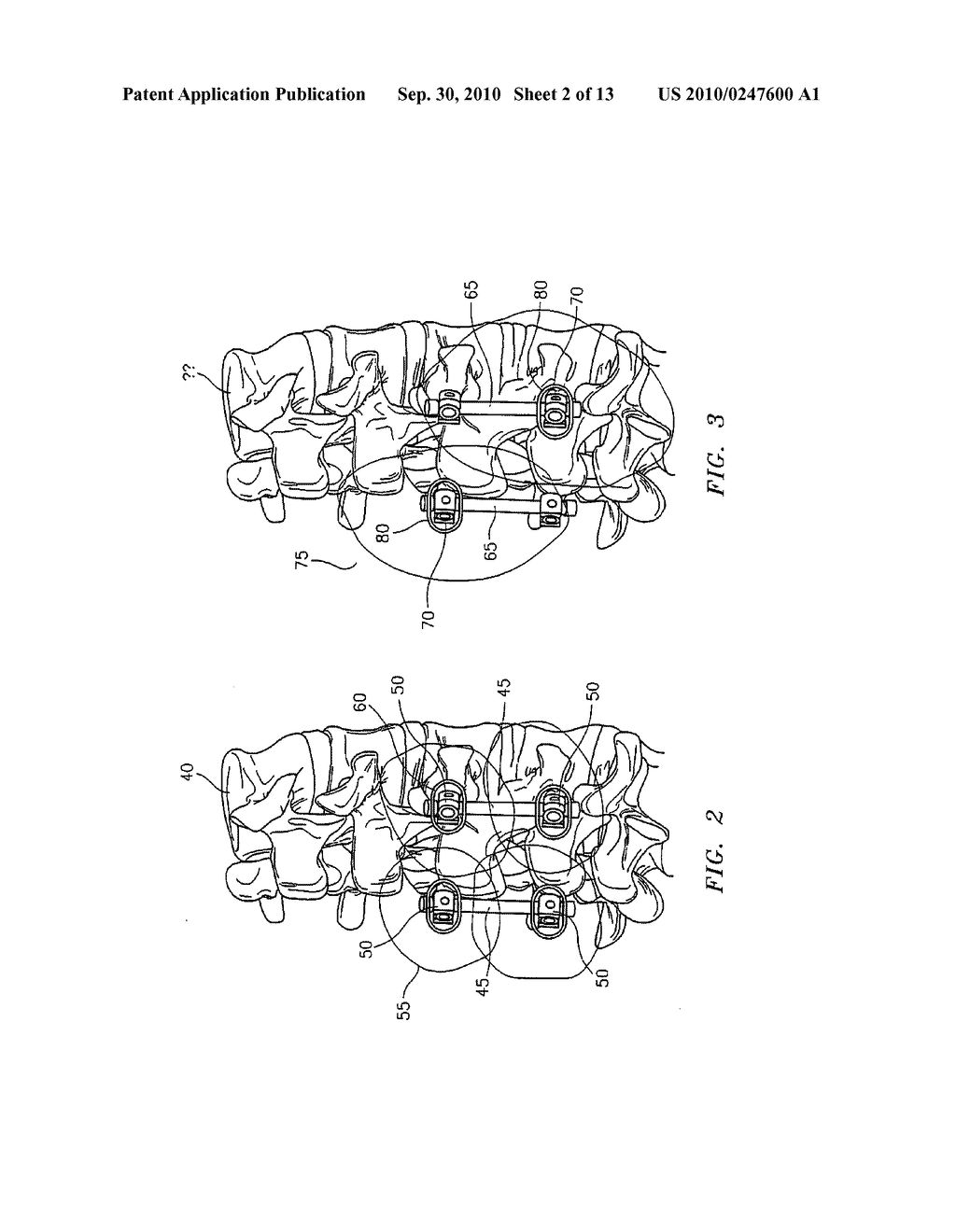 THERAPEUTIC DRUG ELUTING IMPLANT COVER AND METHOD OF MAKING THE SAME - diagram, schematic, and image 03