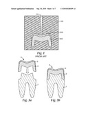 METHOD OF MAKING A FACING FOR A DENTAL RESTORATION, FACING FOR A DENTAL RESTORATION, AND METHOD OF MAKING A DENTAL RESTORATION diagram and image