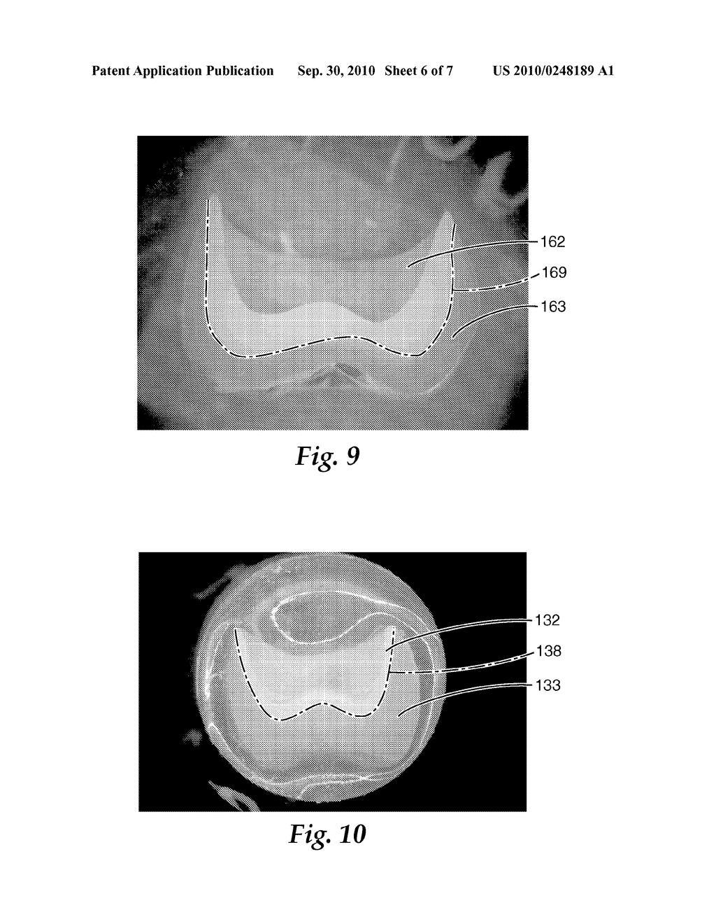 METHOD OF MAKING A FACING FOR A DENTAL RESTORATION, FACING FOR A DENTAL RESTORATION, AND METHOD OF MAKING A DENTAL RESTORATION - diagram, schematic, and image 07