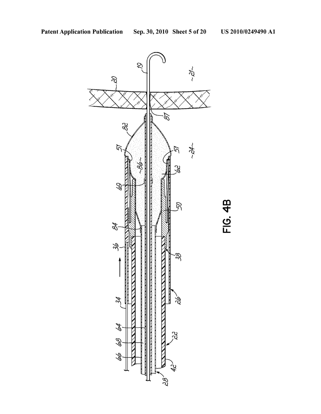 TRANSSEPTAL CANNULA DEVICE, COAXIAL BALLOON DELIVERY DEVICE, AND METHODS OF USING THE SAME - diagram, schematic, and image 06