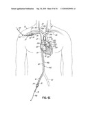 TWO-PIECE TRANSSEPTAL CANNULA, DELIVERY SYSTEM, AND METHOD OF DELIVERY diagram and image