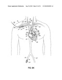 TWO-PIECE TRANSSEPTAL CANNULA, DELIVERY SYSTEM, AND METHOD OF DELIVERY diagram and image