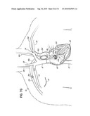 TWO-PIECE TRANSSEPTAL CANNULA, DELIVERY SYSTEM, AND METHOD OF DELIVERY diagram and image