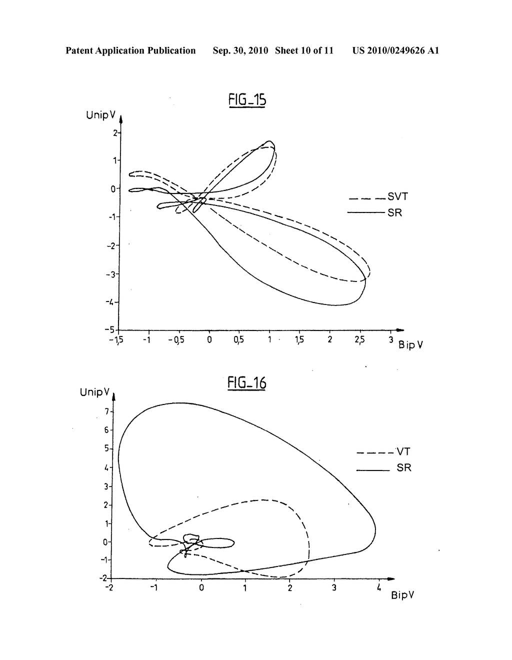 DISCRIMINATING BETWEEN TACHYCARDIAS OF VENTRICULAR ORIGIN AND SUPRA ENTRICULAR ORIGIN, METHODS AND APPARATUS - diagram, schematic, and image 11