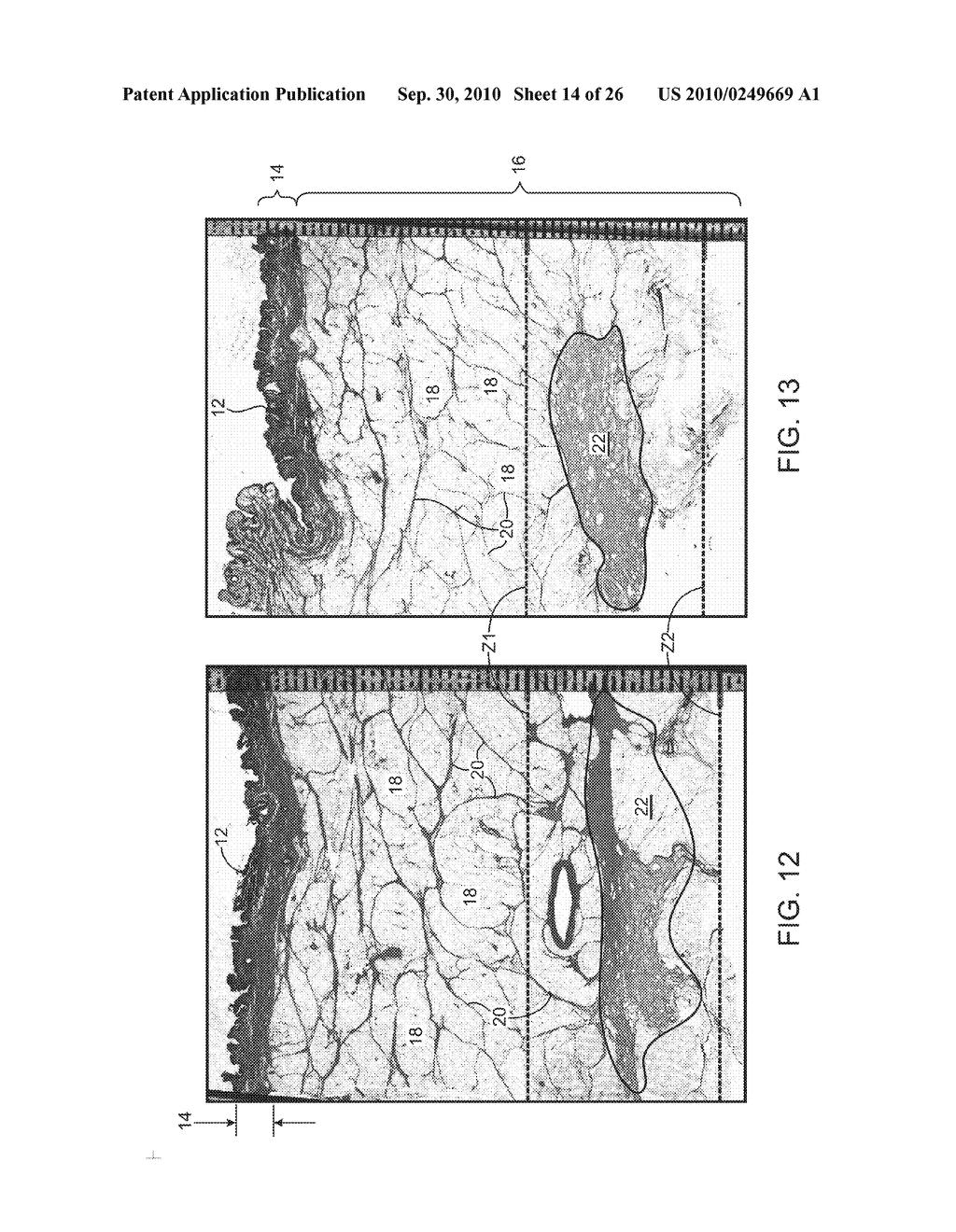 ULTRASONIC TREATMENT OF ADIPOSE TISSUE AT MULTIPLE DEPTHS - diagram, schematic, and image 15