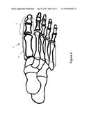 TOE BRACE DESIGNS diagram and image