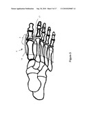 TOE BRACE DESIGNS diagram and image