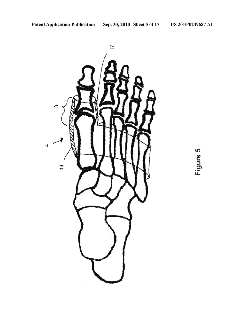 TOE BRACE DESIGNS - diagram, schematic, and image 06