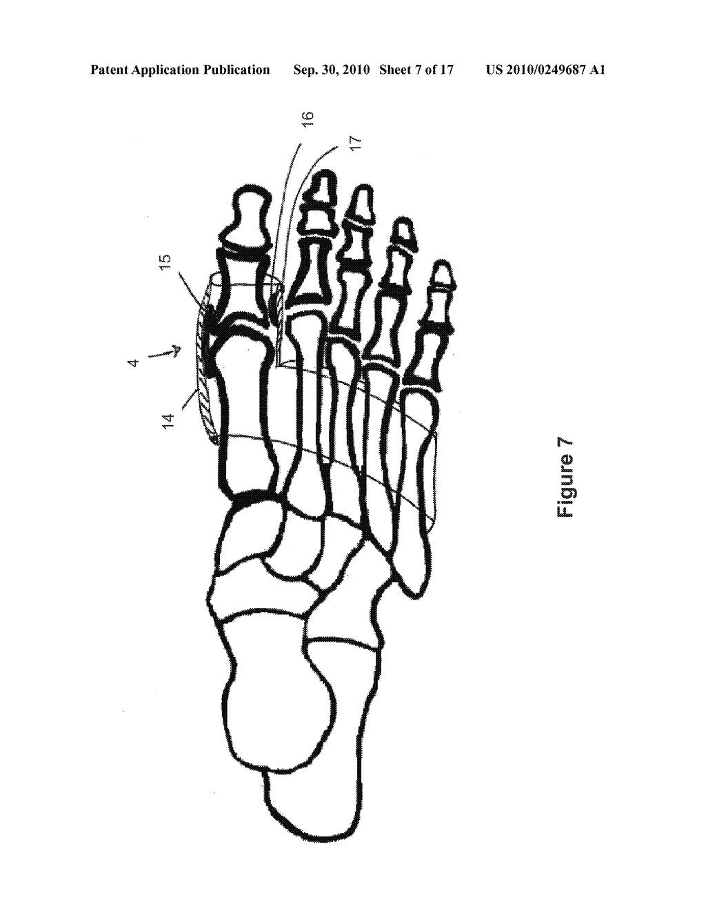 TOE BRACE DESIGNS - diagram, schematic, and image 08