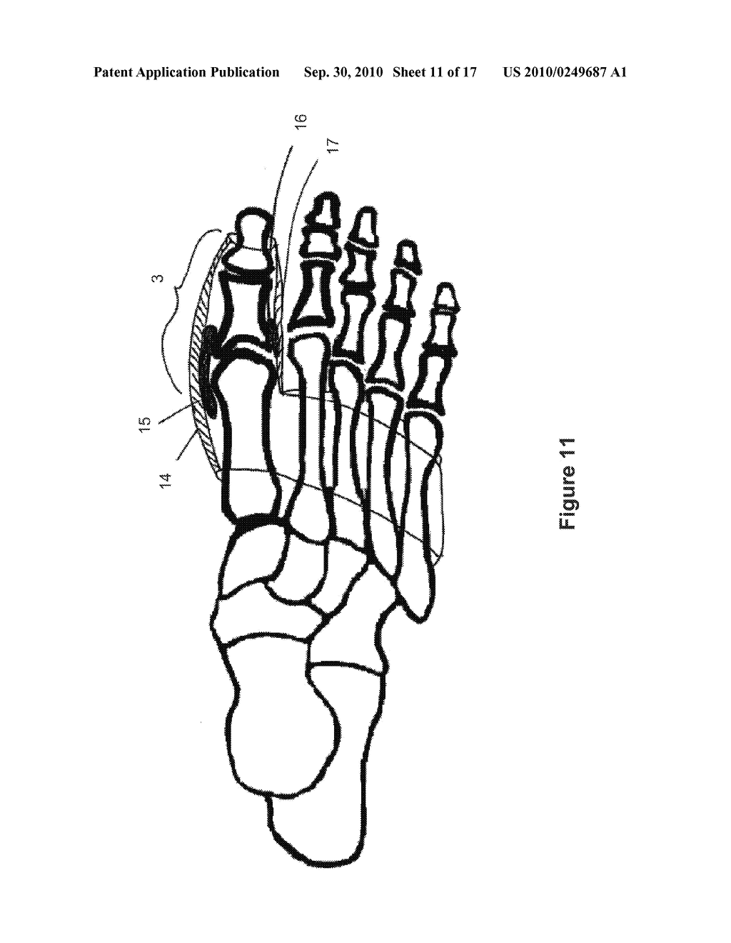 TOE BRACE DESIGNS - diagram, schematic, and image 12