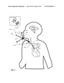 Systems, devices, and methods including infection-Fighting and monitoring shunts diagram and image