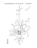 SYSTEMS AND METHODS FOR PROVIDING A SAFETY INTEGRATED CATHETER WITH UNIVERSAL GRIP diagram and image