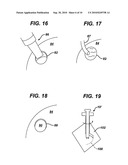 METHODS AND DEVICES FOR PREPARING AND IMPLANTING TISSUE SCAFFOLDS diagram and image