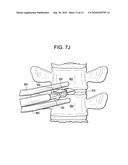 Cervical Motion Disc Inserter diagram and image