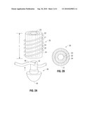 Multizone Implants diagram and image