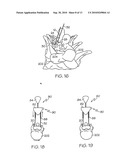 APPARATUS FOR MINIMALLY INVASIVE POSTERIOR CORRECTION OF SPINAL DEFORMITY diagram and image