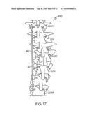 APPARATUS FOR MINIMALLY INVASIVE POSTERIOR CORRECTION OF SPINAL DEFORMITY diagram and image