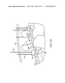 APPARATUS FOR MINIMALLY INVASIVE POSTERIOR CORRECTION OF SPINAL DEFORMITY diagram and image