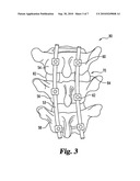 IMPLANTS FORMED OF A SHAPE MEMORY POLYMERIC MATERIAL FOR SPINAL FIXATION diagram and image