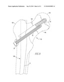 FRACTURE FIXATION DEVICE diagram and image