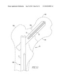 FRACTURE FIXATION DEVICE diagram and image