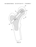 FRACTURE FIXATION DEVICE diagram and image