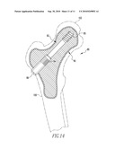 FRACTURE FIXATION DEVICE diagram and image