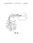 HEMODYNAMIC STABILITY ASSESSMENT BASED ON HEART SOUNDS diagram and image